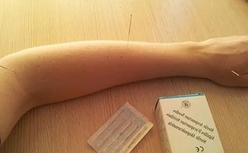 針灸瘦腿穴位有哪些