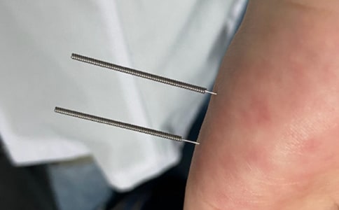 瘦身針灸穴位有哪些