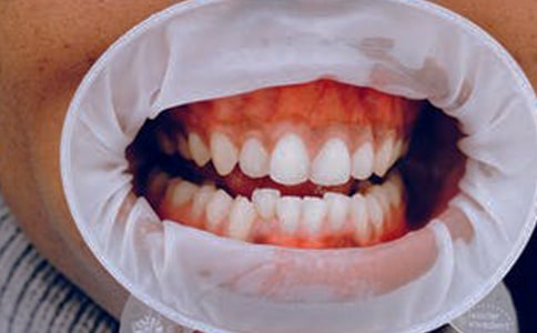 孕婦牙齦大量出血要怎么辦