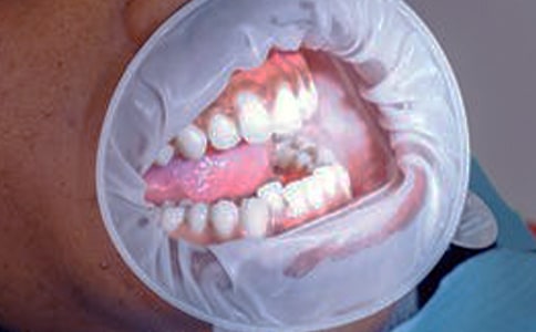 刷牙牙齦出血怎么治呢